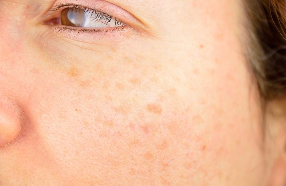 get rid of sunspots on face