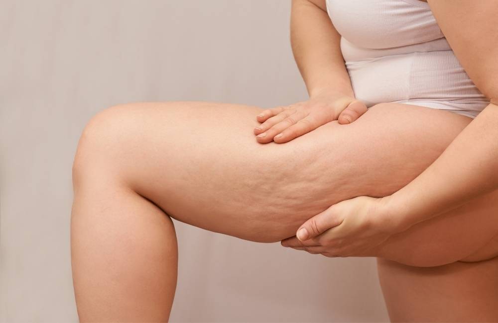 best cosmetic treatments for cellulite